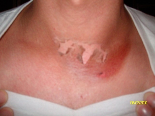 Welder_Flash_Burn